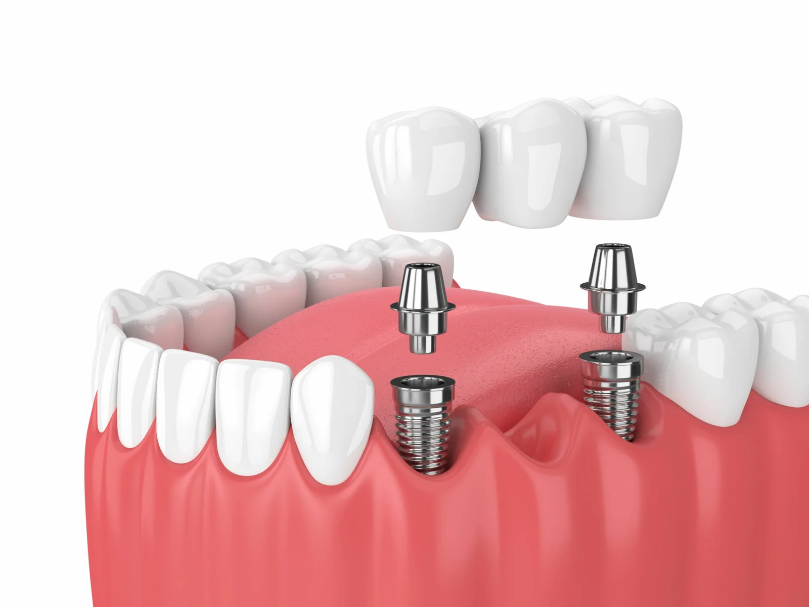 Easy Dental Implants: A Quick & Simple Solution